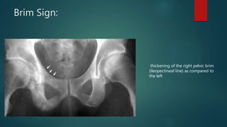 Brim Sign:
thickening of the right pelvic brim
(ileopectineal line) as compared to
the left
 
