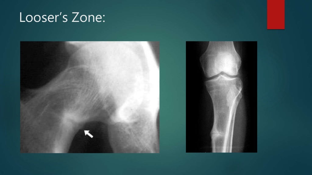Paget’s disease of the bone