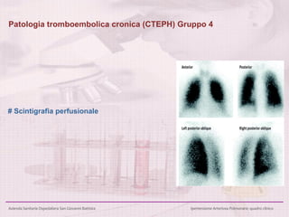 # Scintigrafia perfusionale Patologia tromboembolica cronica (CTEPH) Gruppo 4 