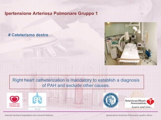 Ipertensione Arteriosa Polmonare Gruppo 1 # Cateterismo destro Right heart catheterization is mandatory to establish a diagnosis of PAH and exclude other causes. 