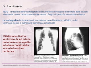 2.  La ricerca ECG  il tracciato elettrocardiografico documenterà l’impegno funzionale delle sezioni destre del cuore: deviazione assiale destra. Segni di ipertrofia ventricolare destra.  La radiografia  del torace porrà in evidenza una dilatazione dell’atrio, e del ventricolo destro   e dell'arteria polmonare ispilaterale Dilatazione di atrio, ventricolo dx ed arteria polmonare con aspetto ad albero potato della vascolarizzazione periferica 
