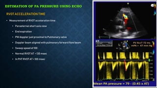 PAH echo - dr abhishek.pptx