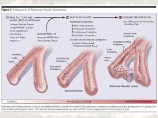 Pulmonary arterial hypertension (PAH) in ccongenital heart diseases | PPTX