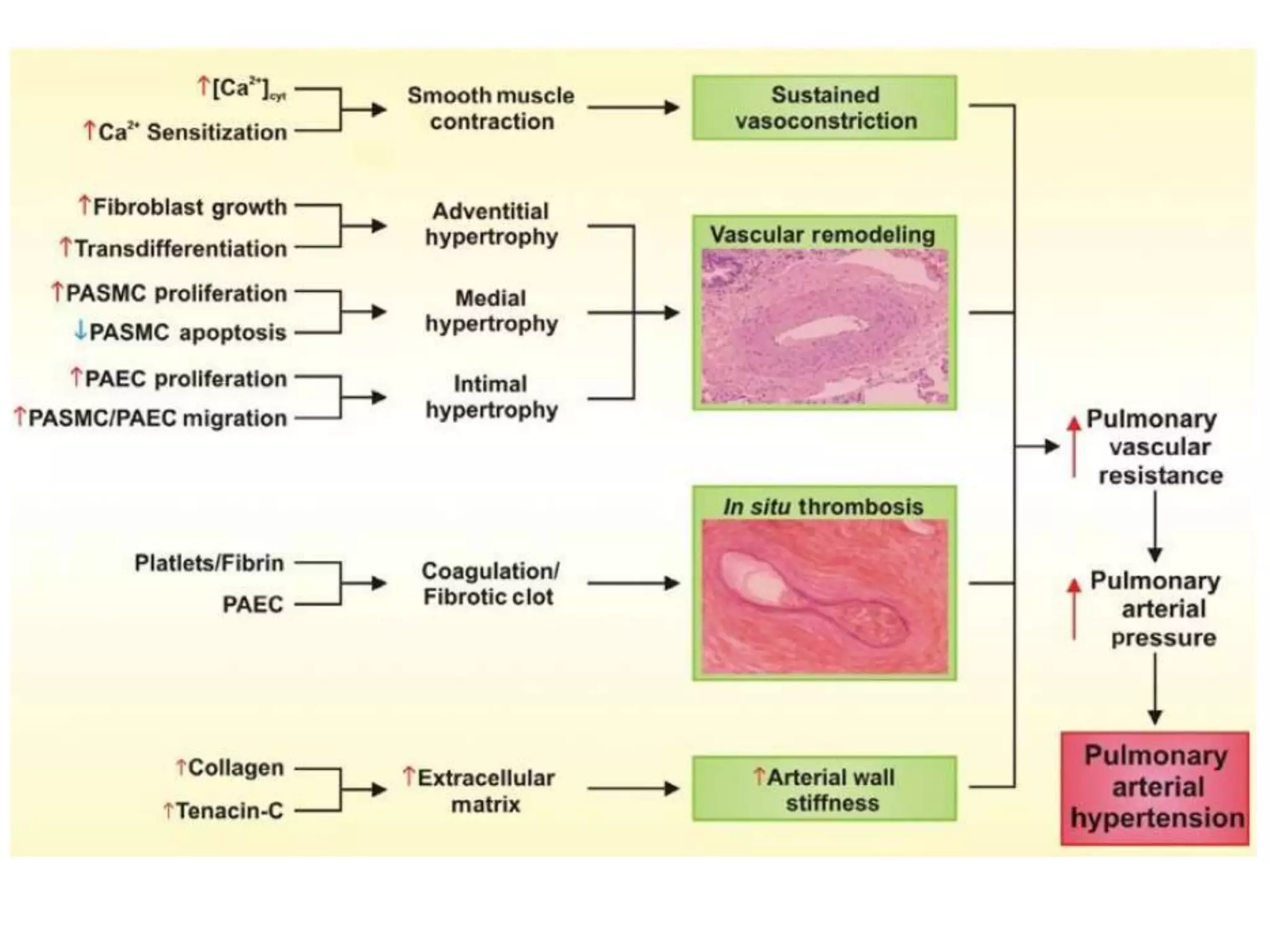 Pulmonary artery Hypertension | PPTX