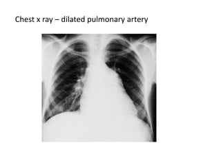 Chest x ray – dilated pulmonary artery
 
