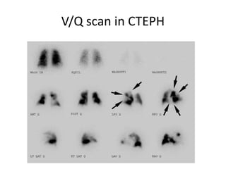 V/Q scan in CTEPH
 