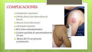 COMPLICACIONES:
 Linfadenitis supurativa
 Osteítis (Infecciòn tuberculosa de
hueso)
 Absceso local subcutaneo
 adenopatía inguinal
 BCG niños inmudeprimidos.
 Cicatriz queloide de aproximadamente
10 mm.
 Menos del 5% no presenta
cicatrización.
 