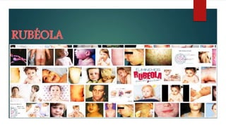 RUBÉOLA
 