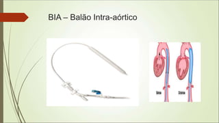BIA – Balão Intra-aórtico
 