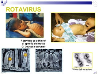 ROTAVIRUS
Virus del rotavirus
Rotavirus se adhieren
al epitelio del tracto
GI (mucosa yeyunal)
10:21 PM
 