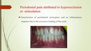 Periodontal pain attributed to hyperocclusion
or -articulation
 Sensitization of periodontal nociceptors and an inflammatory
response due to the excessive loading of the tooth.
 