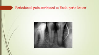 Periodontal pain attributed to Endo-perio lesion
 