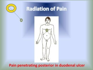 Radiation of Pain
Pain penetrating posterior in duodenal ulcer
 