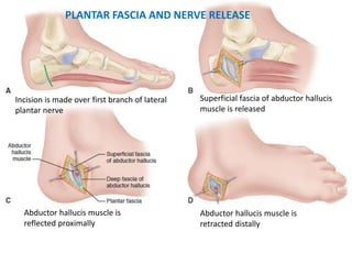 Incision is made over first branch of lateral
plantar nerve
Superficial fascia of abductor hallucis
muscle is released
Abductor hallucis muscle is
reflected proximally
Abductor hallucis muscle is
retracted distally
PLANTAR FASCIA AND NERVE RELEASE
 
