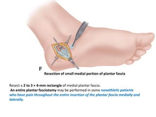Resection of small medial portion of plantar fascia
Resect a 2 to 3 × 4-mm rectangle of medial plantar fascia.
An entire plantar fasciotomy may be performed in some nonathletic patients
who have pain throughout the entire insertion of the plantar fascia medially and
laterally.
 