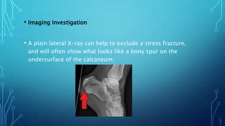 • Imaging Investigation
• A plain lateral X-ray can help to exclude a stress fracture,
and will often show what looks like a bony spur on the
undersurface of the calcaneum.
 