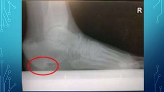 Plantar Fascitis /Painful Heel.pptx