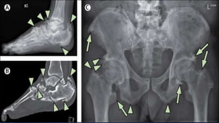 Plantar Fascitis /Painful Heel.pptx