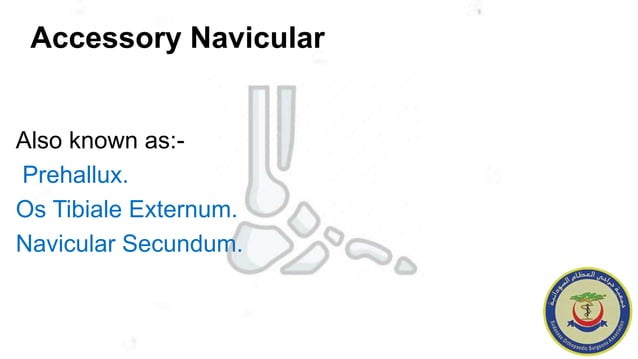 painfull accessory navicular bone(1).pptx | Death, Injury, or Military ...