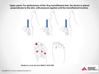 Upper panel: For performance of the 10-g monofilament test, the device is placed 
perpendicular to the skin, with pressure applied until the monofilament buckles. 
Boulton A J et al. Dia Care 2008;31:1679-1685 
Copyright © 2011 American Diabetes Association, Inc. 
 