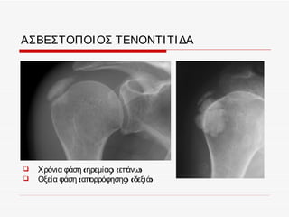 ΑΣΒΕΣΤΟΠΟΙ ΟΣ ΤΕΝΟΝΤΙ ΤΙ ΔΑ




   Χρόνια φάση (ηρεμίας) (επάνω)
   Οξεία φάση (απορρόφησης) (δεξιά)
 