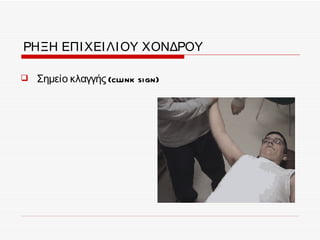 ΡΗΞΗ ΕΠΙ ΧΕΙ ΛΙ ΟΥ ΧΟΝΔΡΟΥ

   Σημείο κλαγγής (clunk sign)
 