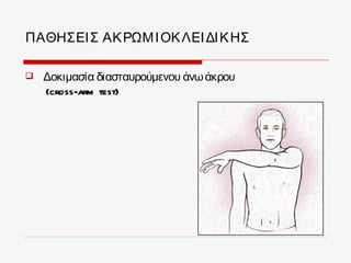 ΠΑΘΗΣΕΙ Σ ΑΚ ΡΩΜ Ι ΟΚ ΛΕΙ ΔΙ Κ ΗΣ

   Δοκιμασία διασταυρούμενου άνω άκρου
    (cross-arm test)
 