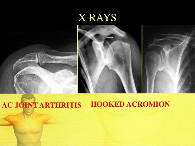 Painful Shoulder