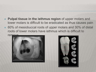  Pulpal tissue in the isthmus region of upper molars and
lower molars is difficult to be eradicated as thus causes pain
 60% of mesiobuccal roots of upper molars and 30% of distal
roots of lower molars have isthmus which is difficult to
remove.
 
