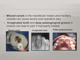  Missed canals in the mandibular molars and maxillary
centrals can cause severe post operative pain
 Invaginated tooth and deep palatogingival groove in
incisors can lead to pain if improperly treated
Invaginated toothMissed canal Palato gingival groove
 