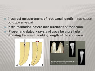  Incorrect measurement of root canal length – may cause
post operative pain
 Instrumentation before measurement of root canal
 Proper angulated x rays and apex locators help in
attaining the exact working length of the root canal.
 