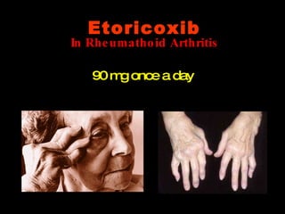 In Rheumathoid Arthritis 90 mg once a day Etoricoxib 