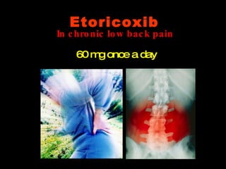 In chronic low back pain 60 mg once a day Etoricoxib 