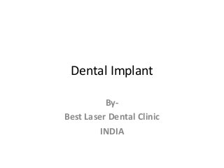 Dental Implant
ByBest Laser Dental Clinic
INDIA

 