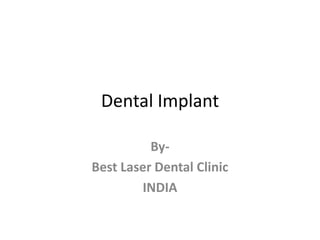 Dental Implant
ByBest Laser Dental Clinic
INDIA

 