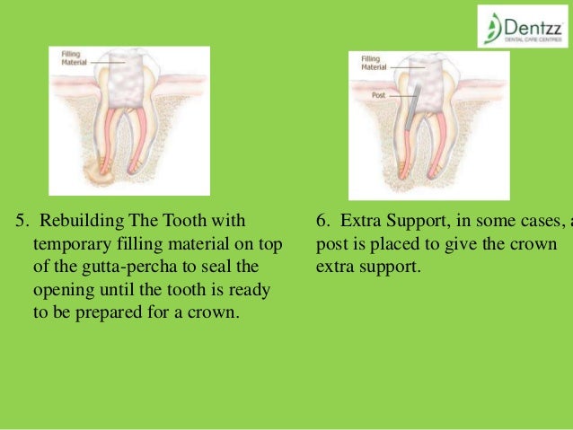Painless Root Canal Treatment at Dentzz Painless Root Canal Treatment at Dentzz