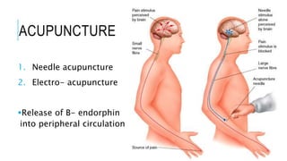 ACUPUNCTURE
1. Needle acupuncture
2. Electro- acupuncture
Release of B- endorphin
into peripheral circulation
 