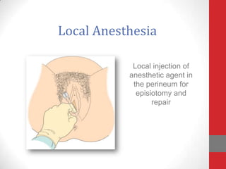 Local Anesthesia
Local injection of
anesthetic agent in
the perineum for
episiotomy and
repair
 