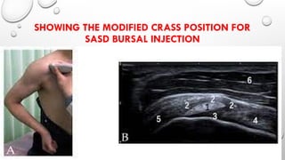 Sasd Injection CHRONIC PAIN MANAGEMENT IN ORTHOPEDIC PRACTICEPPT.pptx