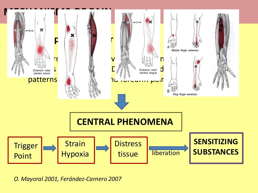 Lateral Epicondylalgia. What do we know about the pain mechanisms?