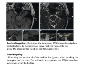 Proximal targeting: , illustrating the location of 50% isodose lines (yellow
circles) relative to the trigeminal nerve root entry zone into the
pons. The green circles stand for the 90% isodose line.
Distal targeting:
, illustrating the location of a 20% isodose line (green circles) touching the
emergence of the pons. The yellow circles represent the 50% isodose line,
which was prescribed 40 Gy.
 
