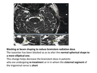 Blocking or beam shaping to reduce brainstem radiation dose
The isocenter has been blocked so as to alter the normal spherical shape to
a more elliptical one.
This change helps decrease the brainstem dose in patients
who are undergoing re-treatment or in in whom the cisternal segment of
the trigeminal nerve is short
 