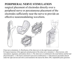 PERIPHERAL NERVE STIMULATION
surgical placement of electrodes directly over a
peripheral nerve or percutaneous placement of the
electrodes sufficiently near the nerve to provide an
effective neuromodulating waveform.
Ulnar nerve stimulation. A, Distribution of the ulnar nerve in the right forearm and hand.
B, Surgical anatomy of the approach and placement of the ulnar nerve stimulator. 1, Skin incision, with
musculature, ligaments, and tendons shown. 2, The ulnar nerve is mobilized in the usual fashion and the lead
placed beneath it. 3, The lead is anchored to prevent its mobilization. C, Subcutaneous pacemaker placed
under the right clavicle and with a cord tunneled to the lead at the elbow. IPG, implantable pulse generator.
 