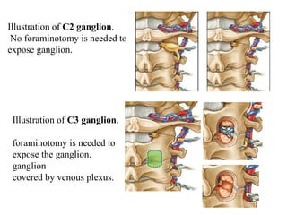 Illustration of C2 ganglion.
No foraminotomy is needed to
expose ganglion.
Illustration of C3 ganglion.
foraminotomy is needed to
expose the ganglion.
ganglion
covered by venous plexus.
 