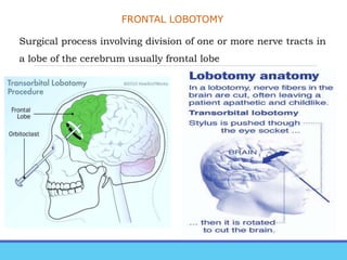 FRONTAL LOBOTOMY
Surgical process involving division of one or more nerve tracts in
a lobe of the cerebrum usually frontal lobe
 