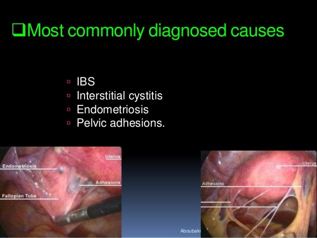 Chronic Pelvic Pain in Women An Evidence based approach