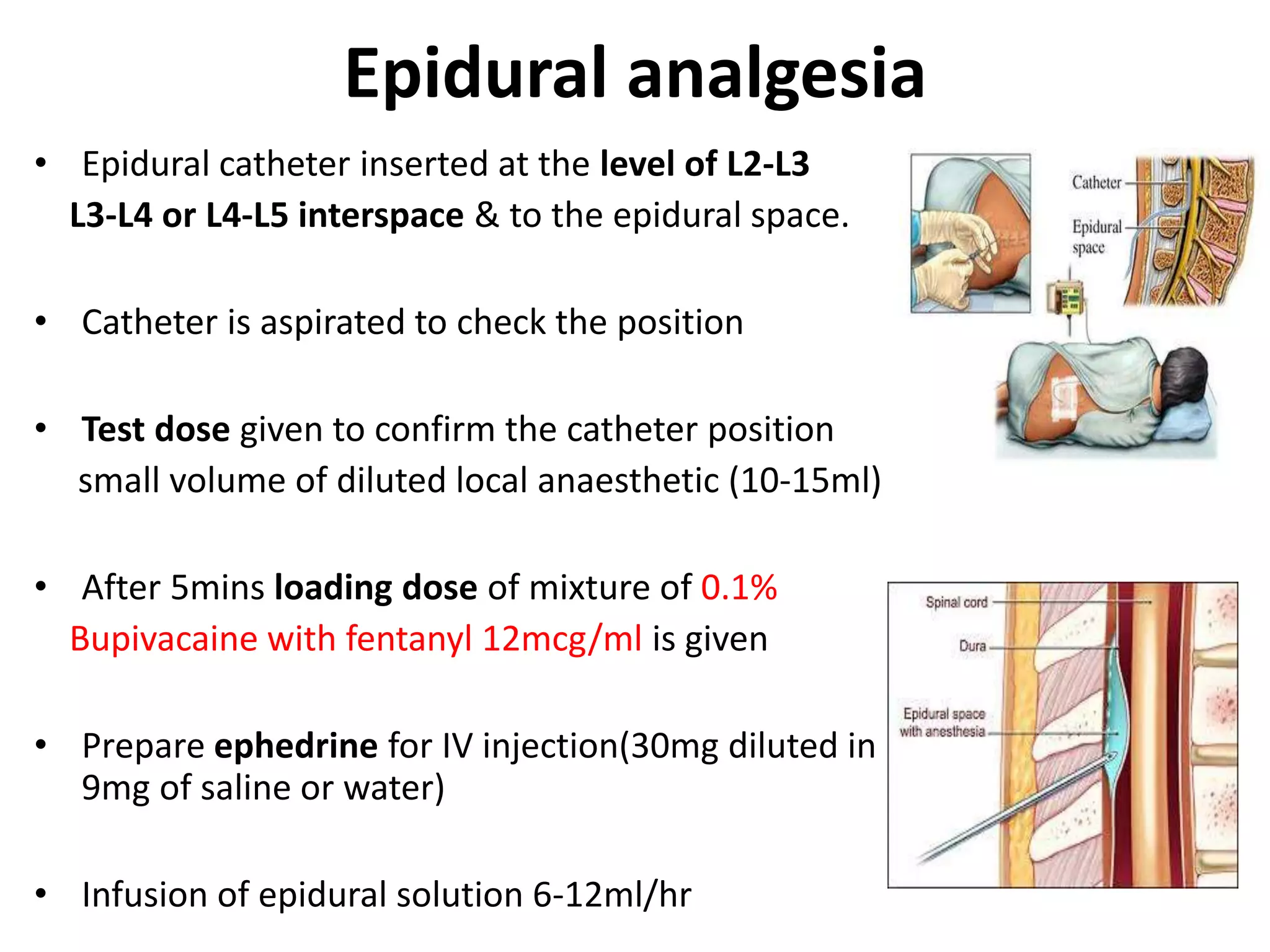 Epidural analgesia 
• Epidural catheter inserted at the level of L2-L3 
L3-L4 or L4-L5 interspace & to the epidural space. 
• Catheter is aspirated to check the position 
• Test dose given to confirm the catheter position 
small volume of diluted local anaesthetic (10-15ml) 
• After 5mins loading dose of mixture of 0.1% 
Bupivacaine with fentanyl 12mcg/ml is given 
• Prepare ephedrine for IV injection(30mg diluted in 
9mg of saline or water) 
• Infusion of epidural solution 6-12ml/hr 
 
