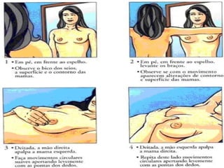 Câncer de Mama
 Câncer mais comum nas brasileiras afeta 11 mil pessoas todos os
anos.
 É o segundo tipo mais freqüente no mundo, o câncer de mama é o mais
comum entre as mulheres, respondendo por 22% dos casos novos a cada
ano. Se diagnosticado e tratado oportunamente, o prognóstico é
relativamente bom.
 Auto-exame procure:
 Caroços
 Abaulamentos
 Retração
 Secreção no mamilo (água)
 