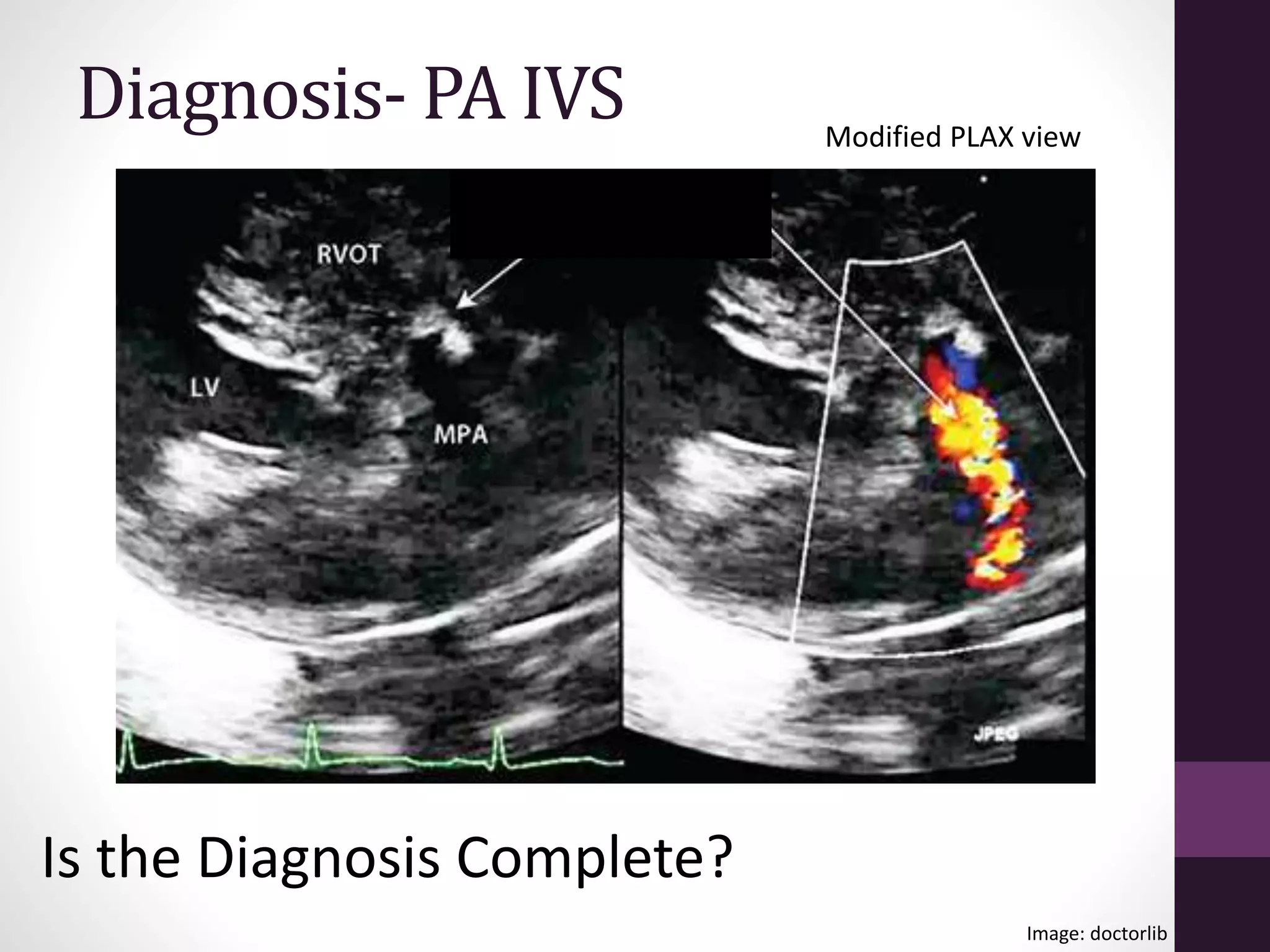 Pulmonary atresia with intact interventricular septum | PPTX