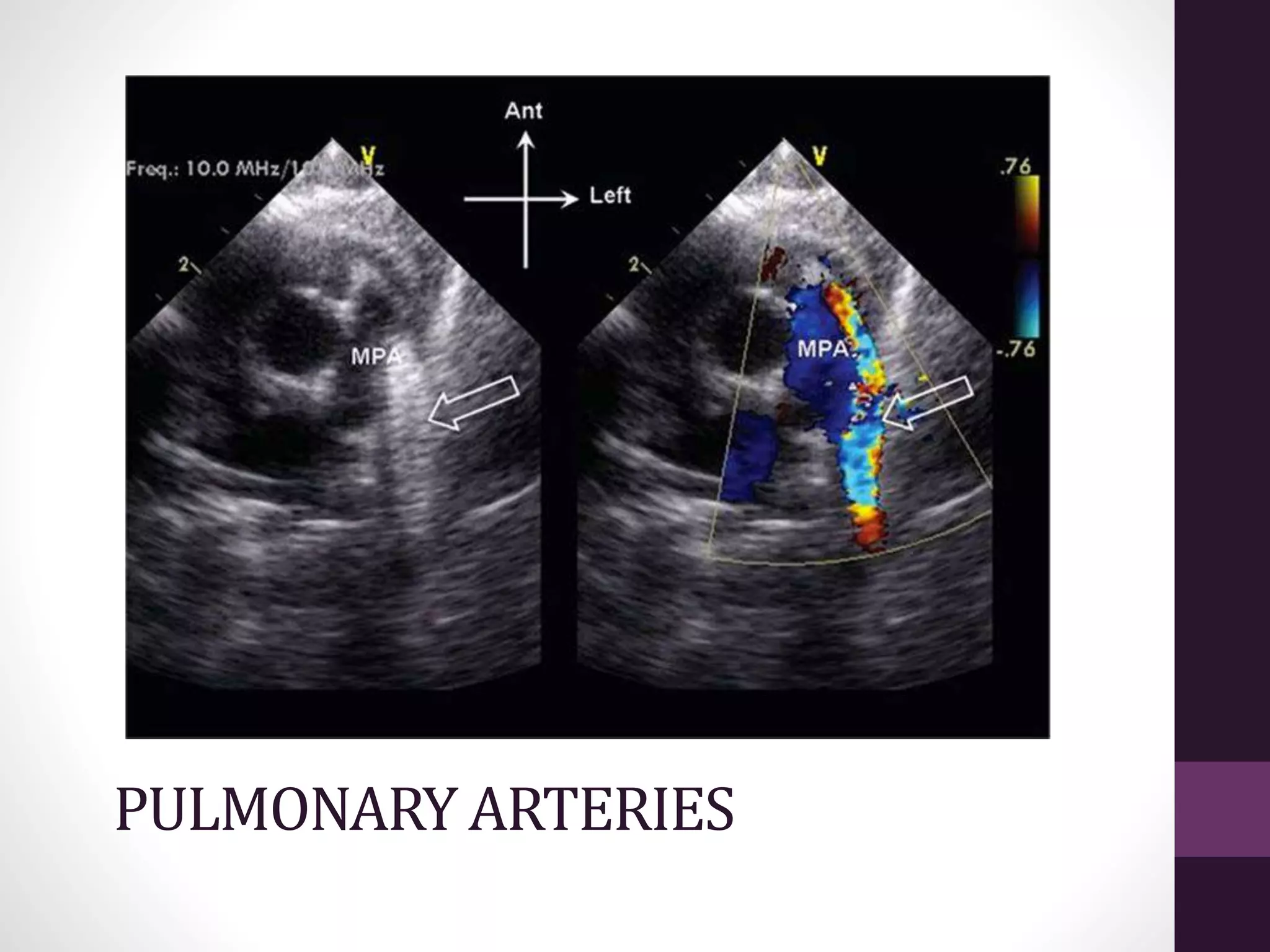 Pulmonary atresia with intact interventricular septum | PPTX